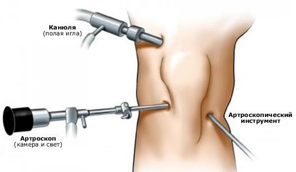 Артроскопија коленског зглоба