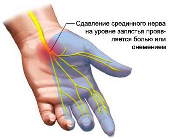 Бол у зглобу