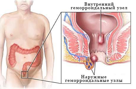 Преваленца хемороида
