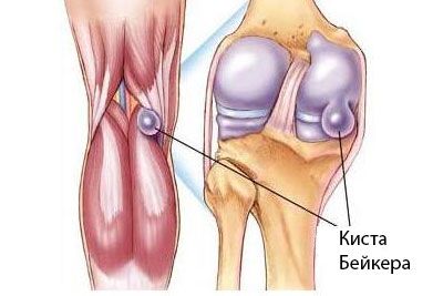 Бејкерова циста