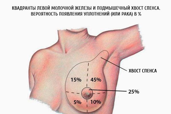 Леви квадранти дојке и аксиларни реп Спенса. Вероватноћа развоја квржица (или рака) у %