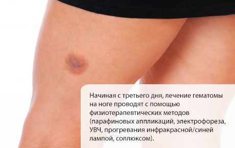 Лечење хематома на нози
