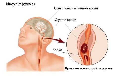 Једноставан тест предвиђа фатални мождани удар