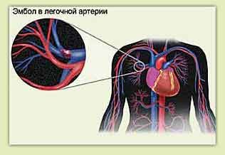 Плућна емболија и болови у грудима са леве стране