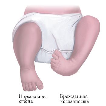 Лечење клупског стопала без операције
